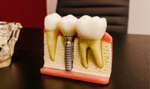implant