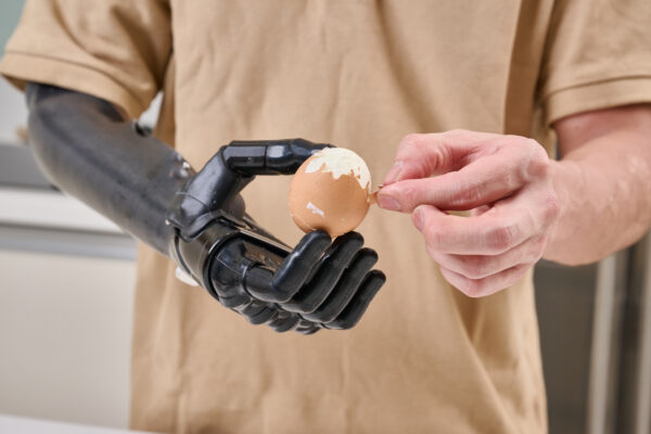 Myoelectric Prosthetics - Image 2